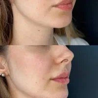 تزریق و اموزش ژل وبوتاکس ومز وتراپی