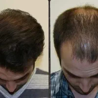 دیگه از کچلی خجالت نکش