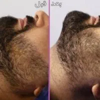 عمل زیبایی توسط پزشک متخصص(ساکشن غبغب.بلفاروپلاستی