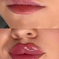 تخفیف ژل ‌‌لب،بوتاکس،زاویه سازی در کلینیک 420/000