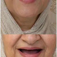 دندان دندانسازی دندانپزشکی ایمپلنت مصنوعی کامپوزیت