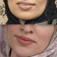 فیلربوتاکس مزوتراپی پی آرپی کاشت مووابرو چسب بخیه