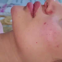 فیلر لب|خدمات آرایشگری و زیبایی|زاهدان, |دیوار