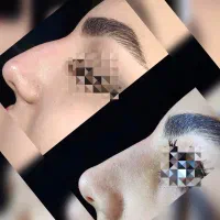 زیبایی نیلگون تخفیف میکروبلیدینگ،فیبروز،فیلر(ژل)