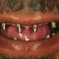 خدمات تخصصی ایمپلنت پایه ۱۶/۰۰۰/۰۰۰