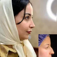جراحی بینی برای اردبیلی ها/پیزوسرجری/42میلیون