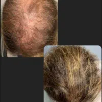 ترکیدگی پیاز چه موهات