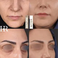 جراحی بینی ابدو‌ساکشن بلفارو(پلک) تیپ پلاستی کاشت|خدمات آرایشگری و زیبایی|مشهد, سجاد شهر|دیوار