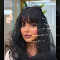 جشنواره تخفیفی ژل و بوتاکس/وام/اقساطی