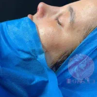 جراحی زیبایی بینی و صورت با فرم طبیعی
