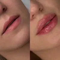 تخفیف استثنایی فیلر/بوتاکس/لیزر/هایفو /فیشال