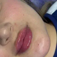 مدل برای تزریق ژل و بوتاکس زیر نظر پزشک