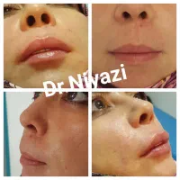 ژل لب|خدمات آرایشگری و زیبایی|مشهد, سجاد شهر|دیوار
