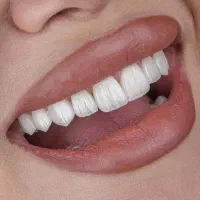 ایمپلنت ارتودنسی لمینت روکش کامپوزیت
