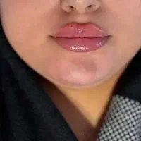 مرکز تخصصی بوتاکس،ژل(فیلر)،خالبرداری و پرسینگ