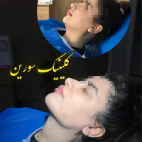 سوپر کانتور ( V line )