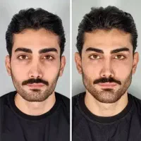 تزریق فیلر،بوتاکس،جوانساز،لیزر،مزو تراپی