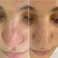 فشیال تخصصی با مواد کلینیکال، مزو مو تضمینی