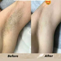 افتتاحیه لیزرموتخفیف ویژه به مدت سه روز ۵۰درصد