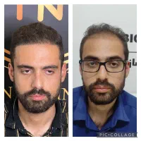 کاشت مو،ریش بادستگاه بدون جراحی ویژه۹.۸۰۰.۰۰۰تومان