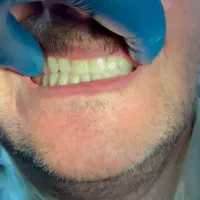 دندان مصنوعی(دندانسازی)با بیمه