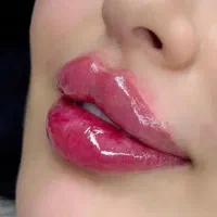 خدمات ژل بوتاکس مزو  شرایطی