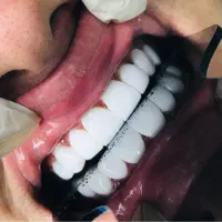 کامپوزیت دندان تضمینی و درجه یک|خدمات آرایشگری و زیبایی|کرج, کرج نو|دیوار