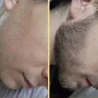 رویش ریش و سیبیل