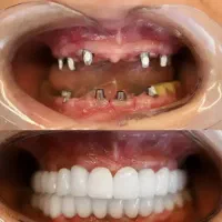 ایمپلنت ایرانی تحت لیسانس کره ۶۵۰۰