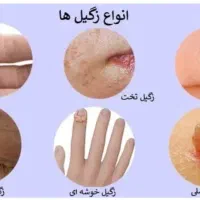 درمان زگیل،تبخال تناسلی خانمهاو آقایان،درمطب متخصص
