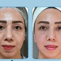 مزو تراپی مو ،پی آر پی ،خالبرداری ،هیر فیلر