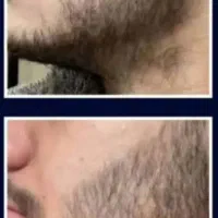پرپشتی ریش و سبیل