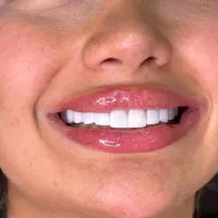 دندانپزشکی،کامپوزیت، لمینیت