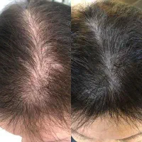 چرا کاشت انتخاب کردی