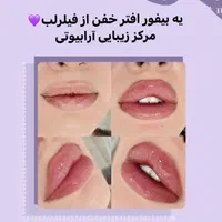 ژل وفیلرلب گونه، زاویه،فول فیس وبوتاکس درمطب دکتر