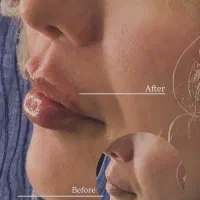 جشنواره ژل لب ، بوتاکس ،نخ لیفت