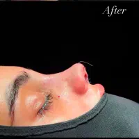 جراحی بینی اقساطی کلینیک مهرزاد