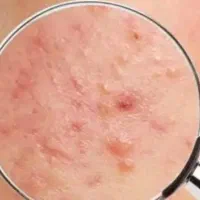 کرم ضد جوش صدرصد تضمینی