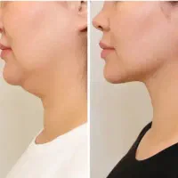 جشنواره از بین بردن غبغب با مزو چربی سوز فقط 2800