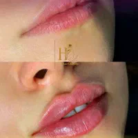 فیلر ، بوتاکس ، پی آر پی ، مزو