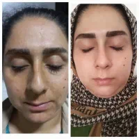 کرم بیوممتیک ضدلک جوانسازی ماندگار