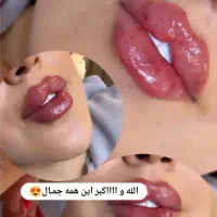 ژل لب ۶۵۰بوتاکس ۶۵۰برند مصبورت توسط پزشک متخصص
