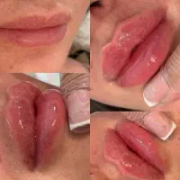 تزریق بوتاکس،قیمت ویژه،فرم دهی و جوانسازی