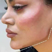 ژل وبوتاکس ساکشن غبغب تخلیه و تزریقی چربی