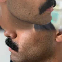 ژل لب/فیلر/کات گونه/پیرسینگ/بوتاکس