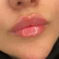 ژل و بوتاکس.مزو صورت کلینیک زیبایی با تخفیف