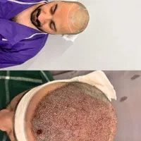 کاشت مو برای اولین بار در ورزقان