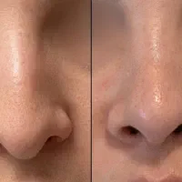 تغییر فرم بینی بدون جراحی