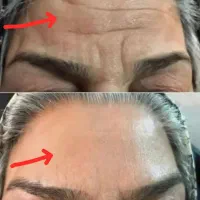 چین و چروک صورتت خلاص شو
