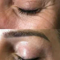 تخفیف ویژه لیزر پلک و چین و چروک های صورت